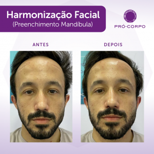harmonização-8ml2-masculina